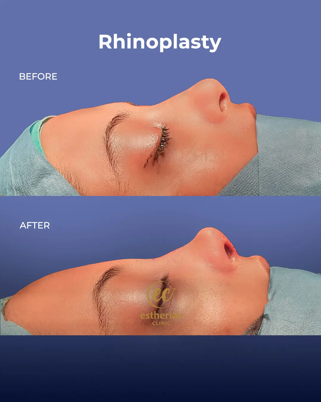 Rhinoplasty Before and After by the Estherian Clinic