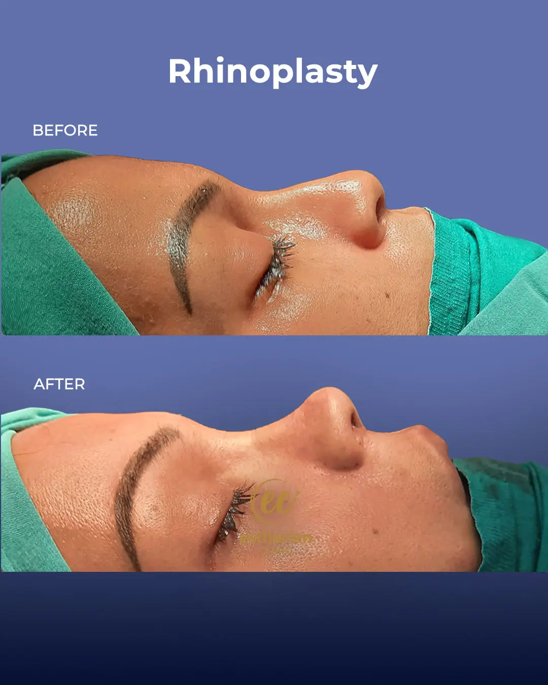 Rhinoplasty Before and After by the Estherian Clinic