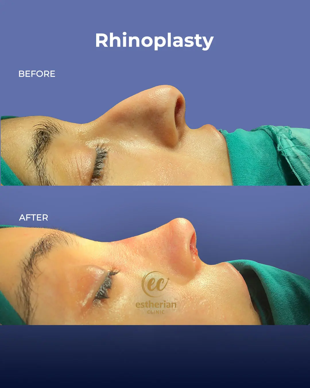 Rhinoplasty Before and After by the Estherian Clinic