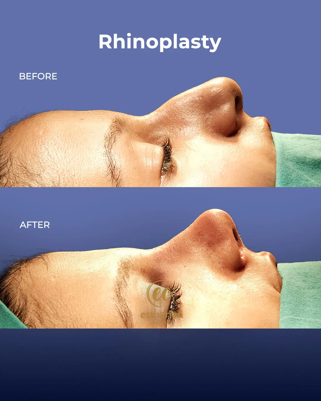 Rhinoplasty Before and After by the Estherian Clinic