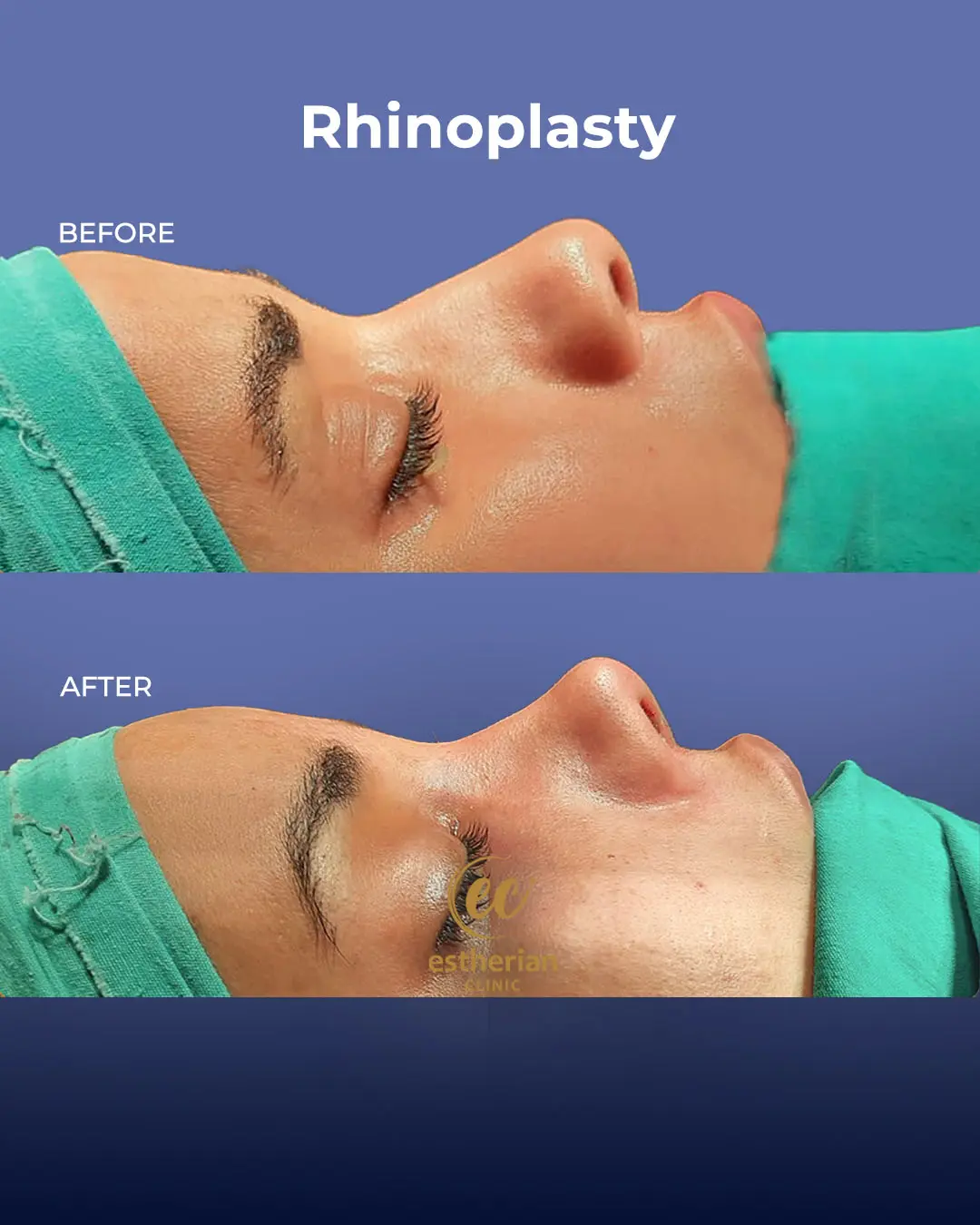 Rhinoplasty Before and After by the Estherian Clinic