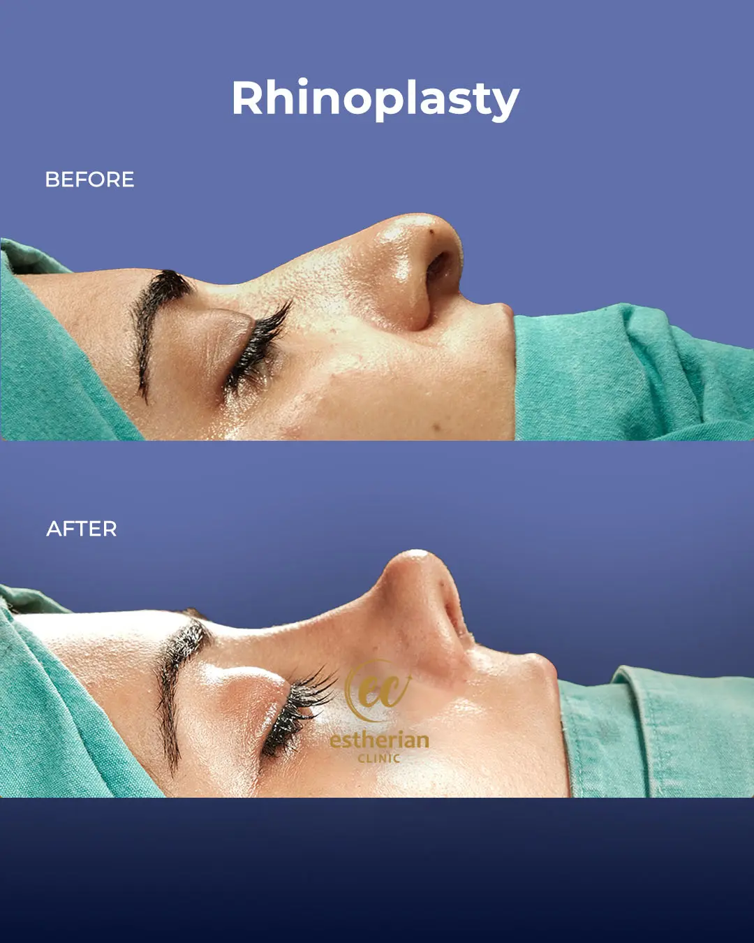 Rhinoplasty Before and After by the Estherian Clinic