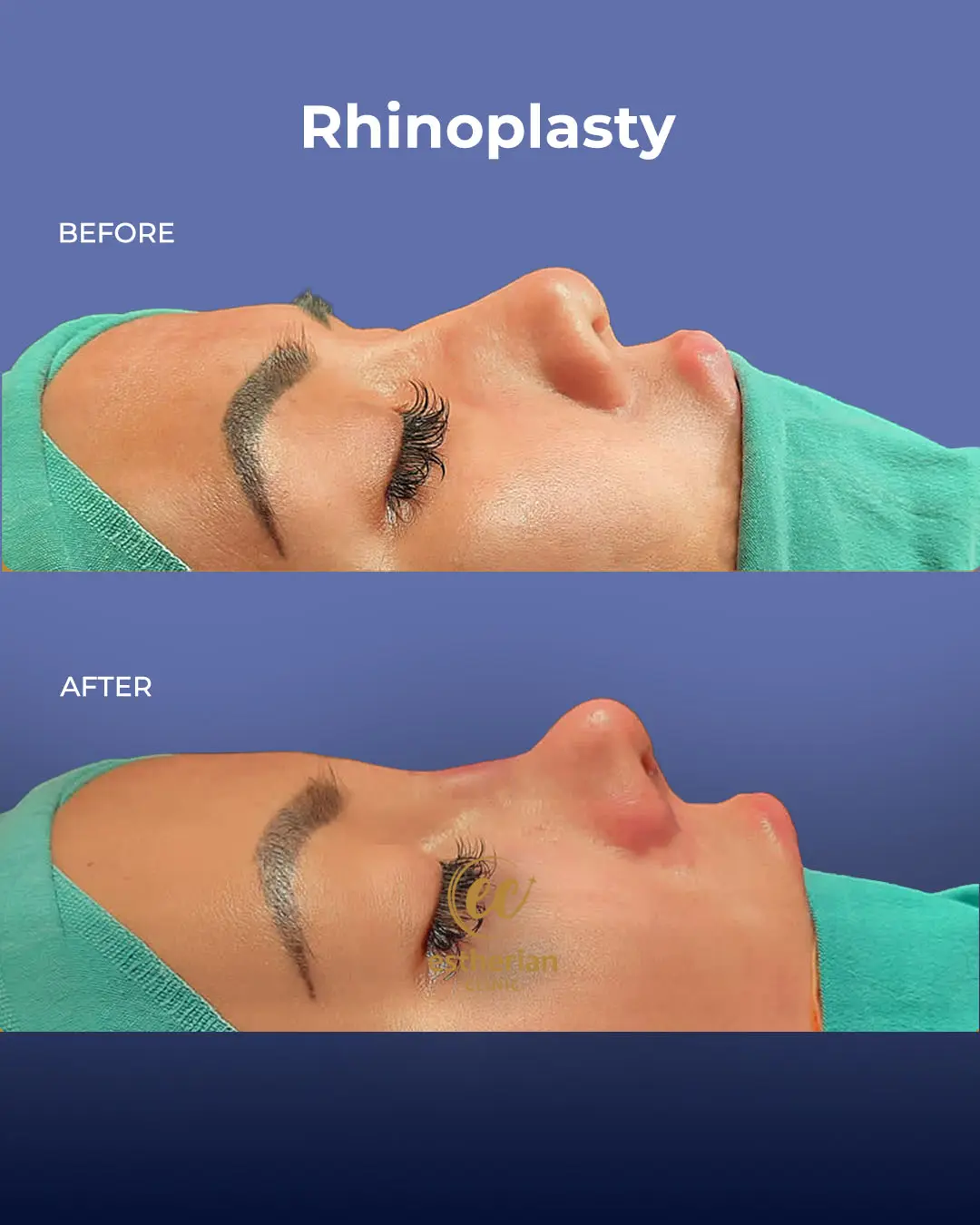 Rhinoplasty Before and After by the Estherian Clinic