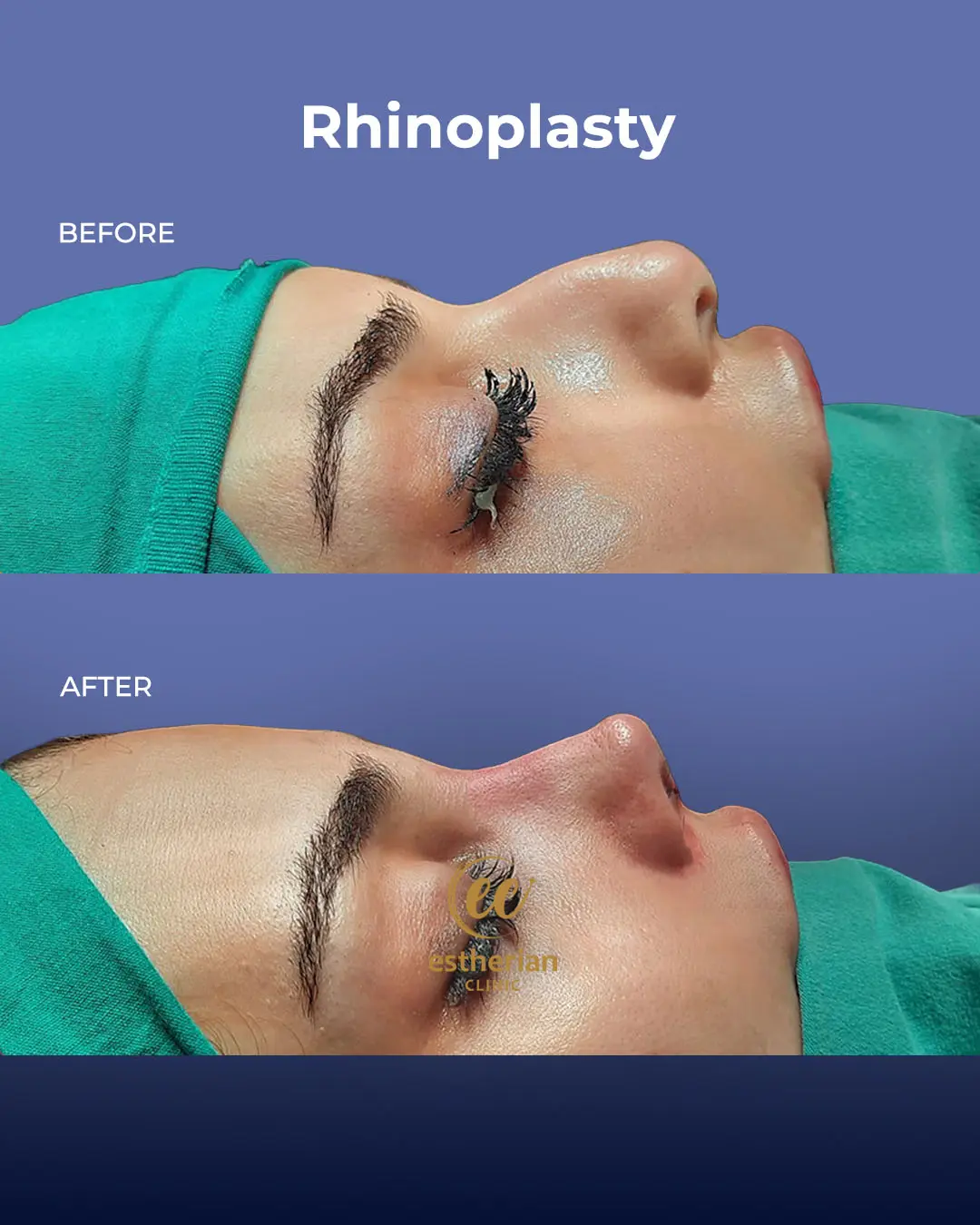 Rhinoplasty Before and After by the Estherian Clinic