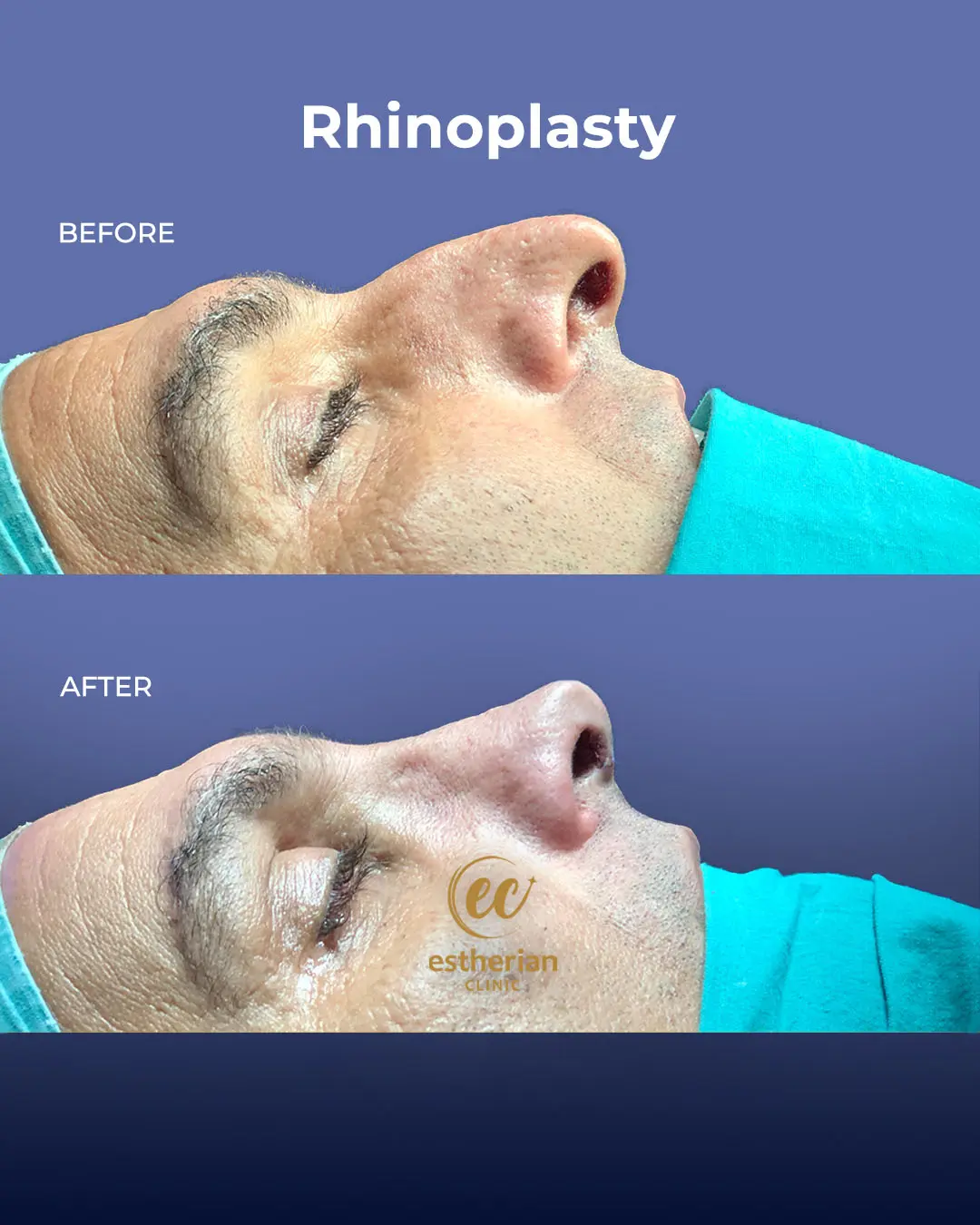 Rhinoplasty Before and After by the Estherian Clinic