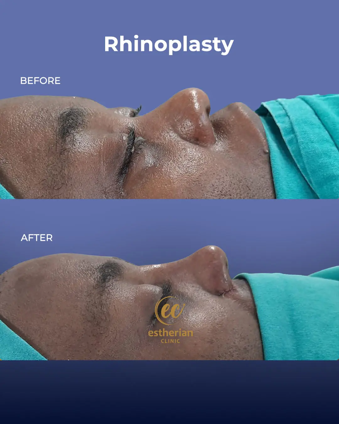 Rhinoplasty Before and After by the Estherian Clinic