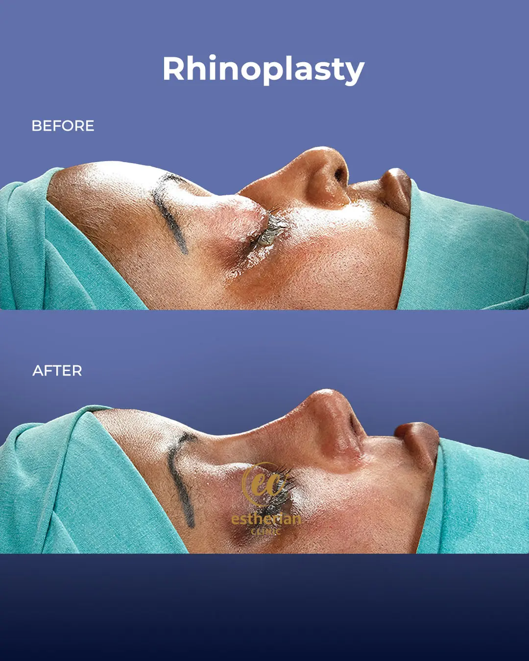 Rhinoplasty Before and After by the Estherian Clinic