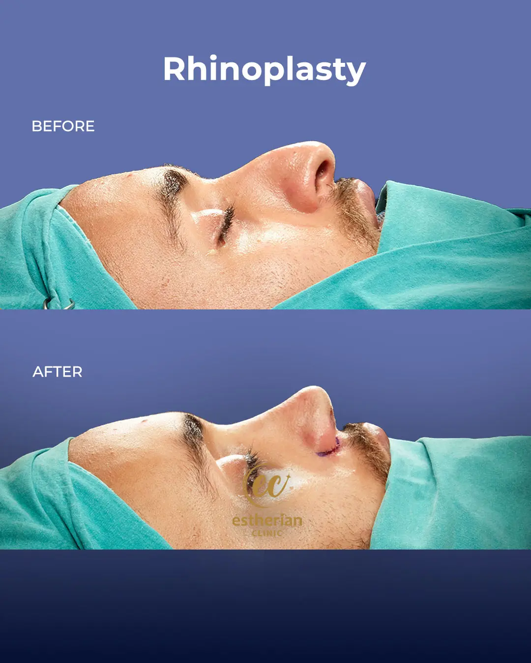 Rhinoplasty Before and After by the Estherian Clinic