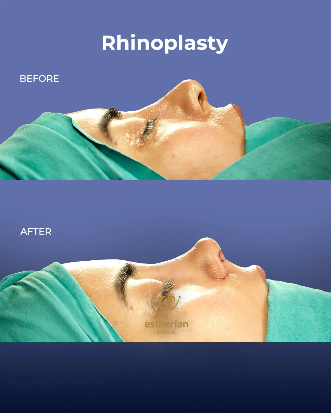 Rhinoplasty Before and After by the Estherian Clinic