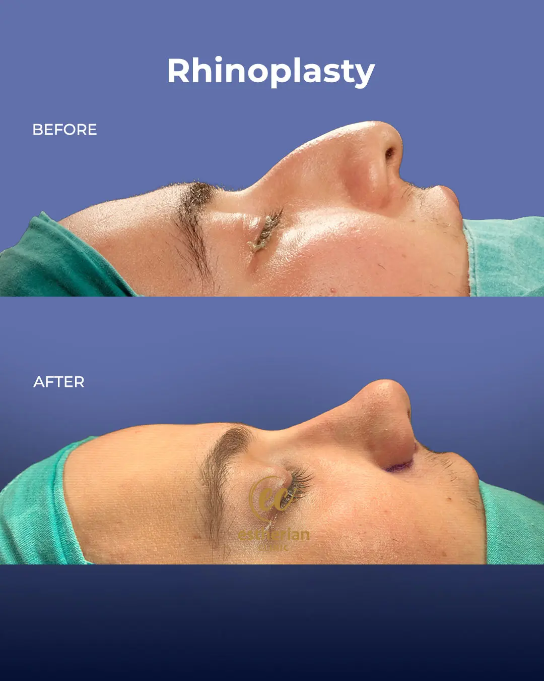 Rhinoplasty Before and After by the Estherian Clinic