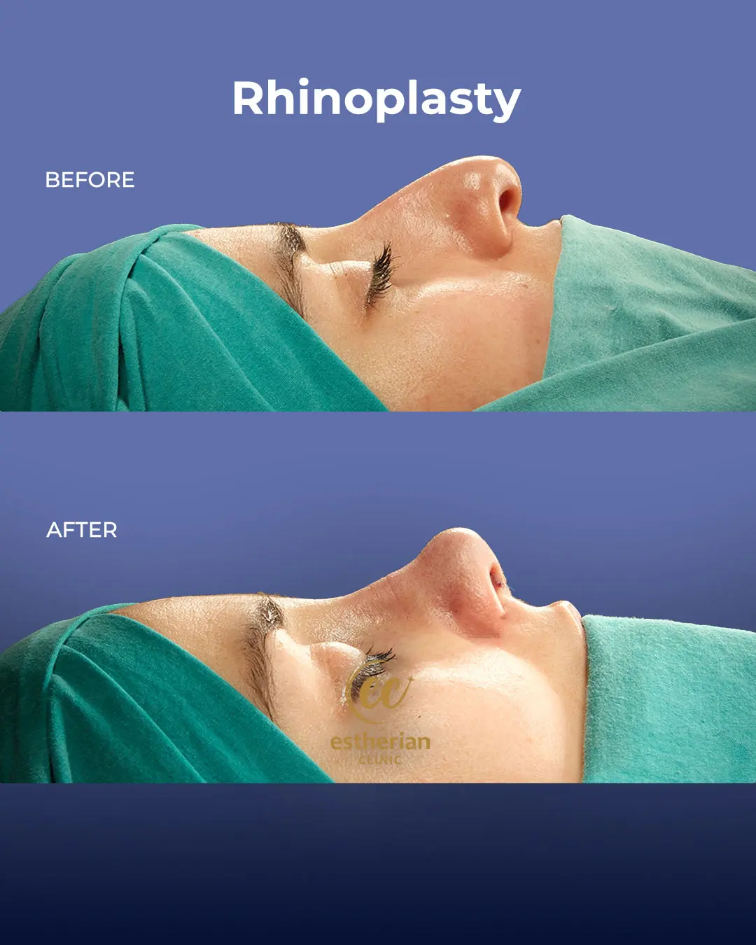 Rhinoplasty Before and After by the Estherian Clinic