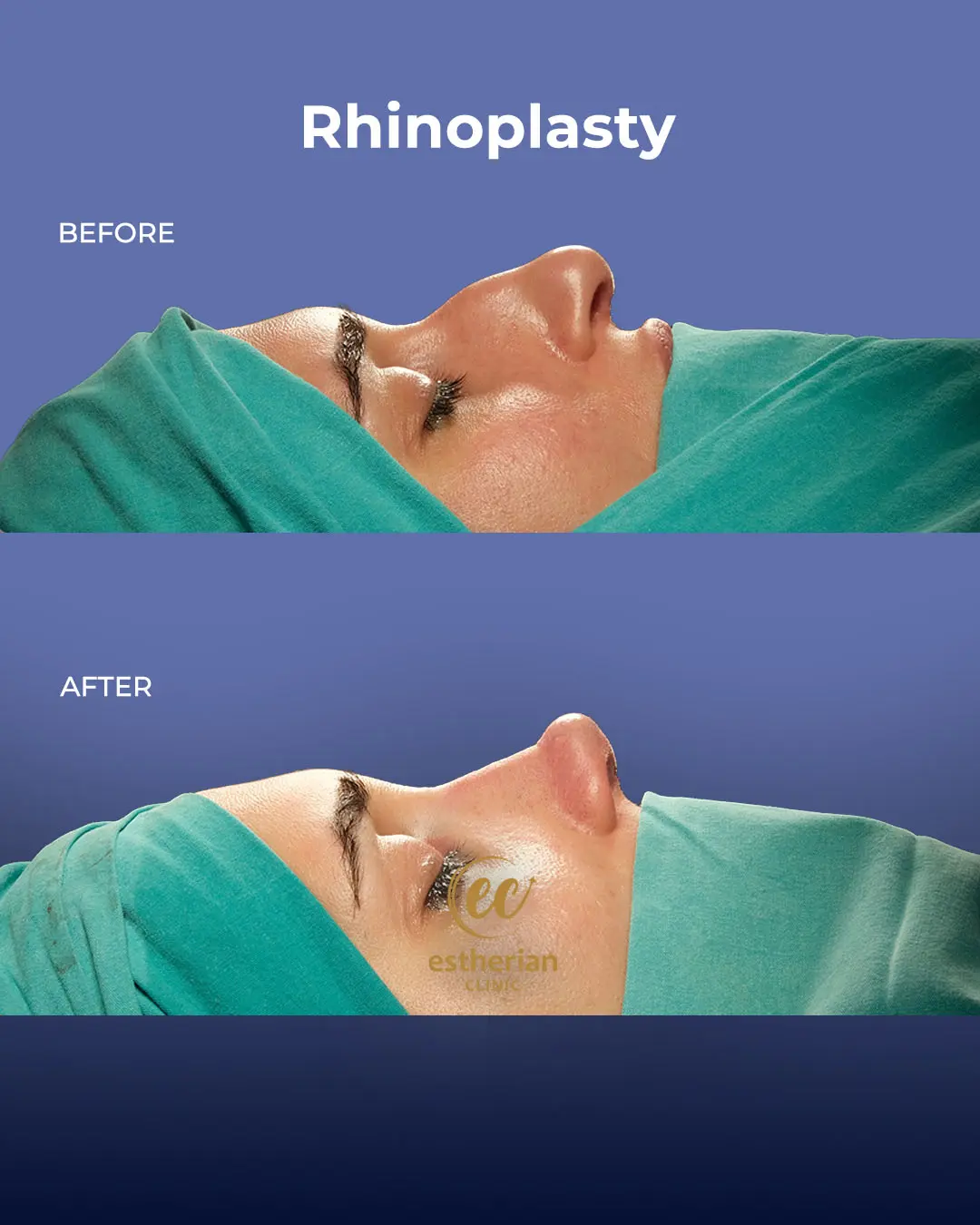 Rhinoplasty Before and After by the Estherian Clinic