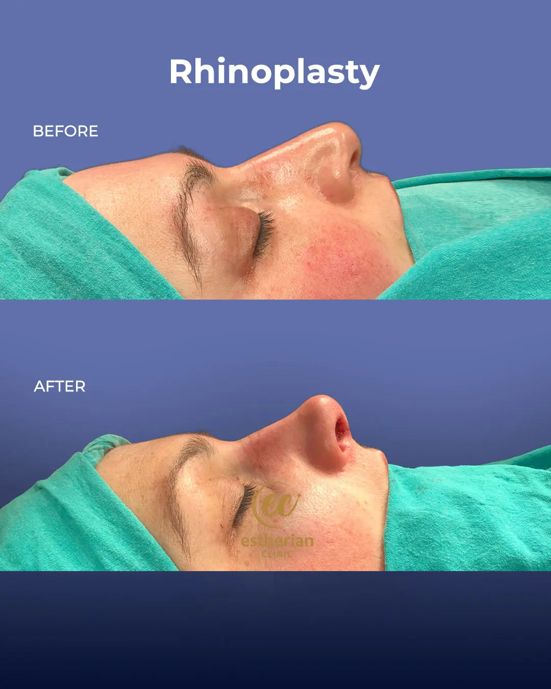 Rhinoplasty Before and After by the Estherian Clinic