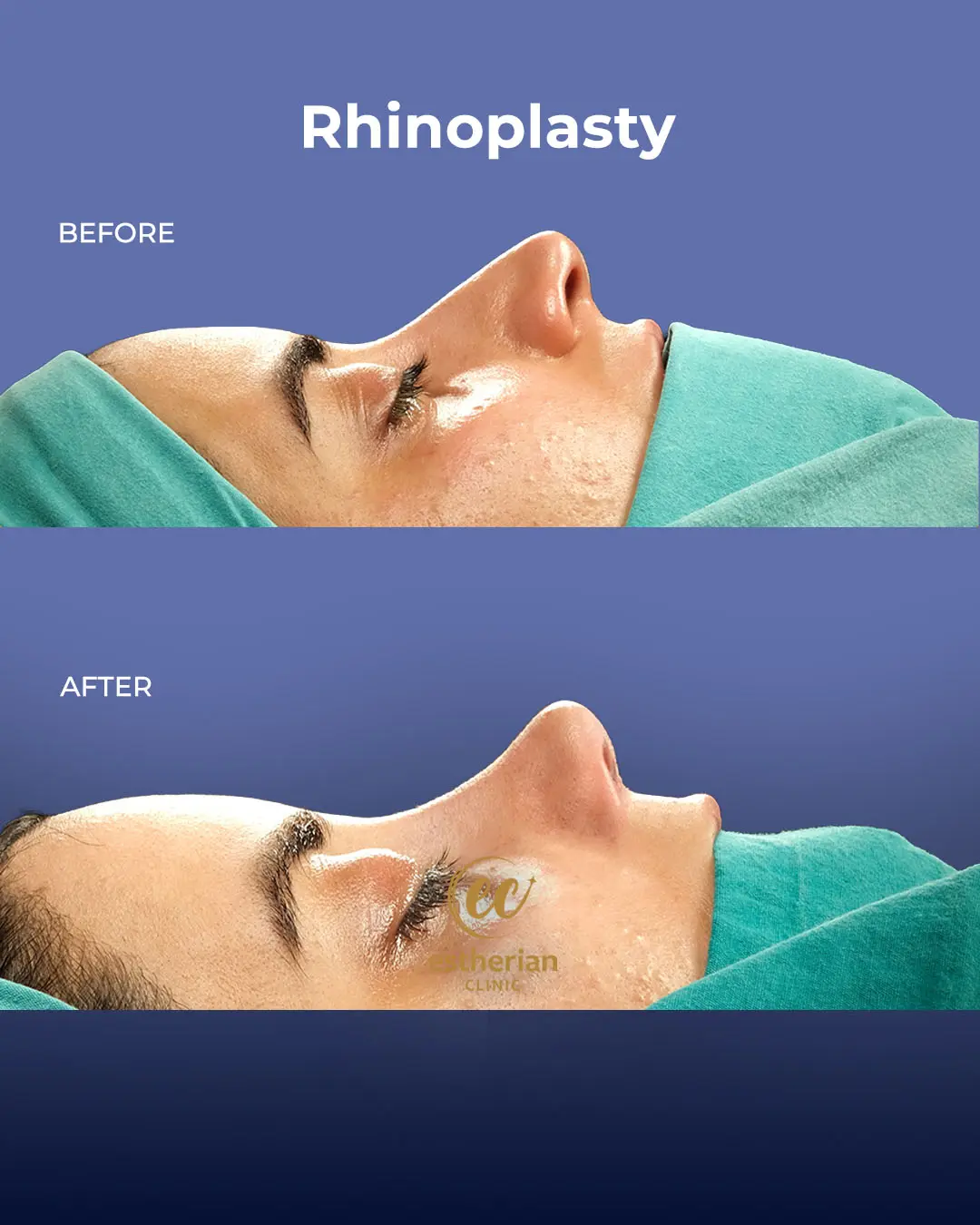 Rhinoplasty Before and After by the Estherian Clinic