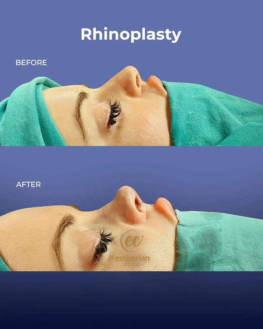 Rhinoplasty Before and After by the Estherian Clinic