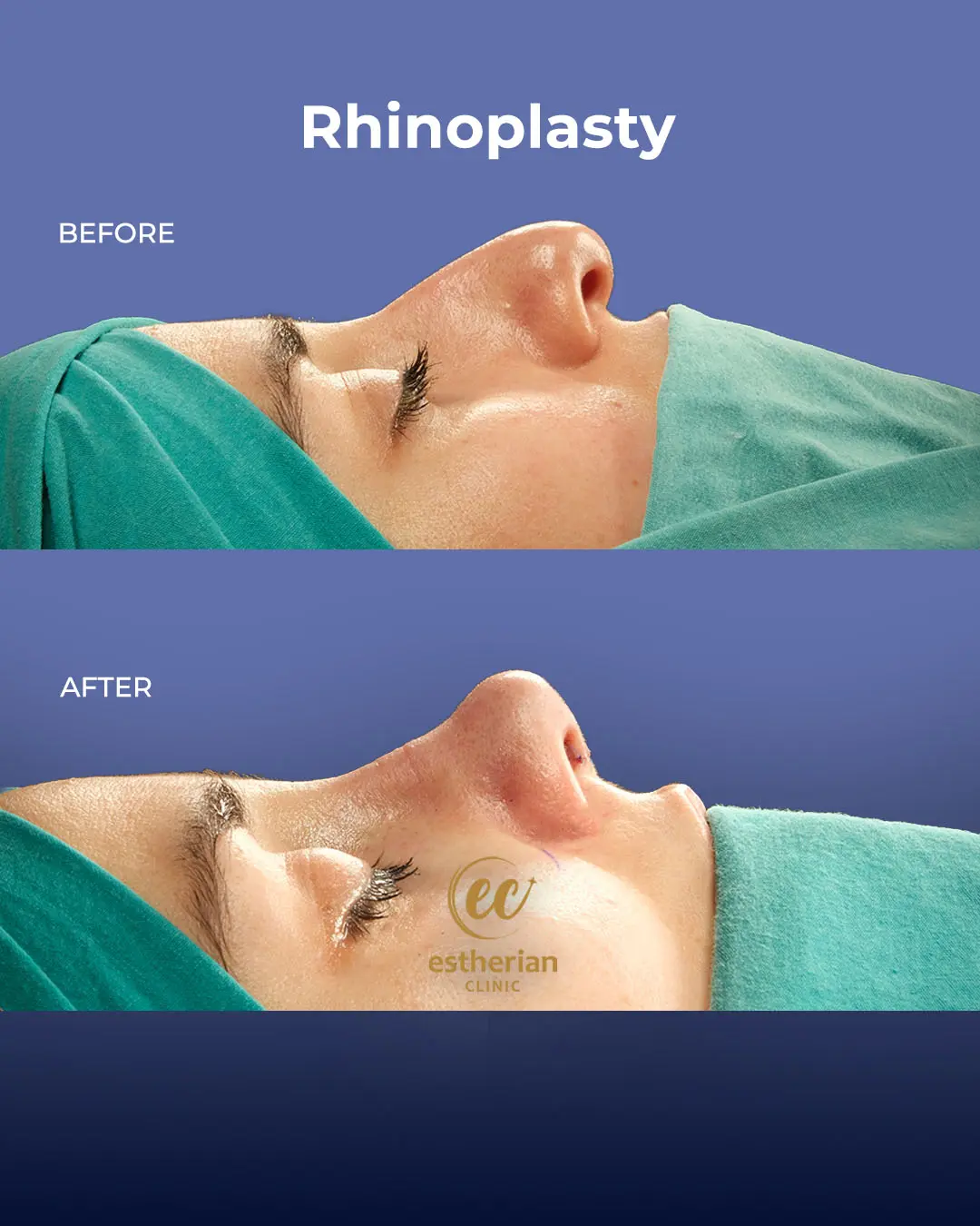Rhinoplasty Before and After by the Estherian Clinic