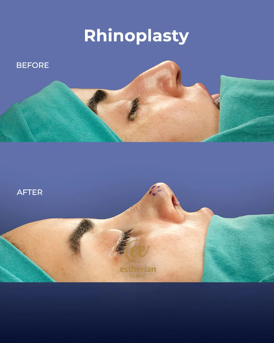 Rhinoplasty Before and After by the Estherian Clinic