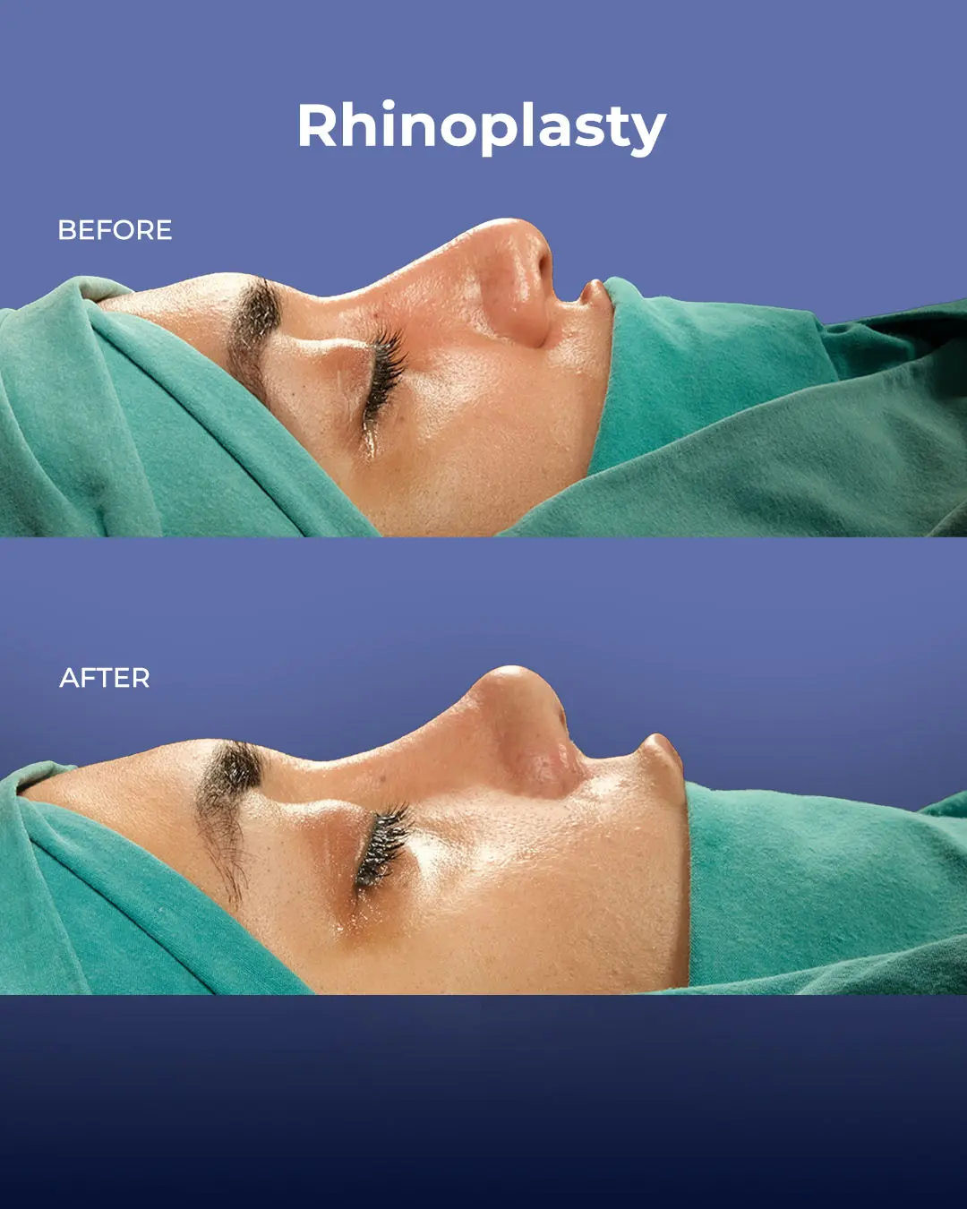 Rhinoplasty Before and After by the Estherian Clinic