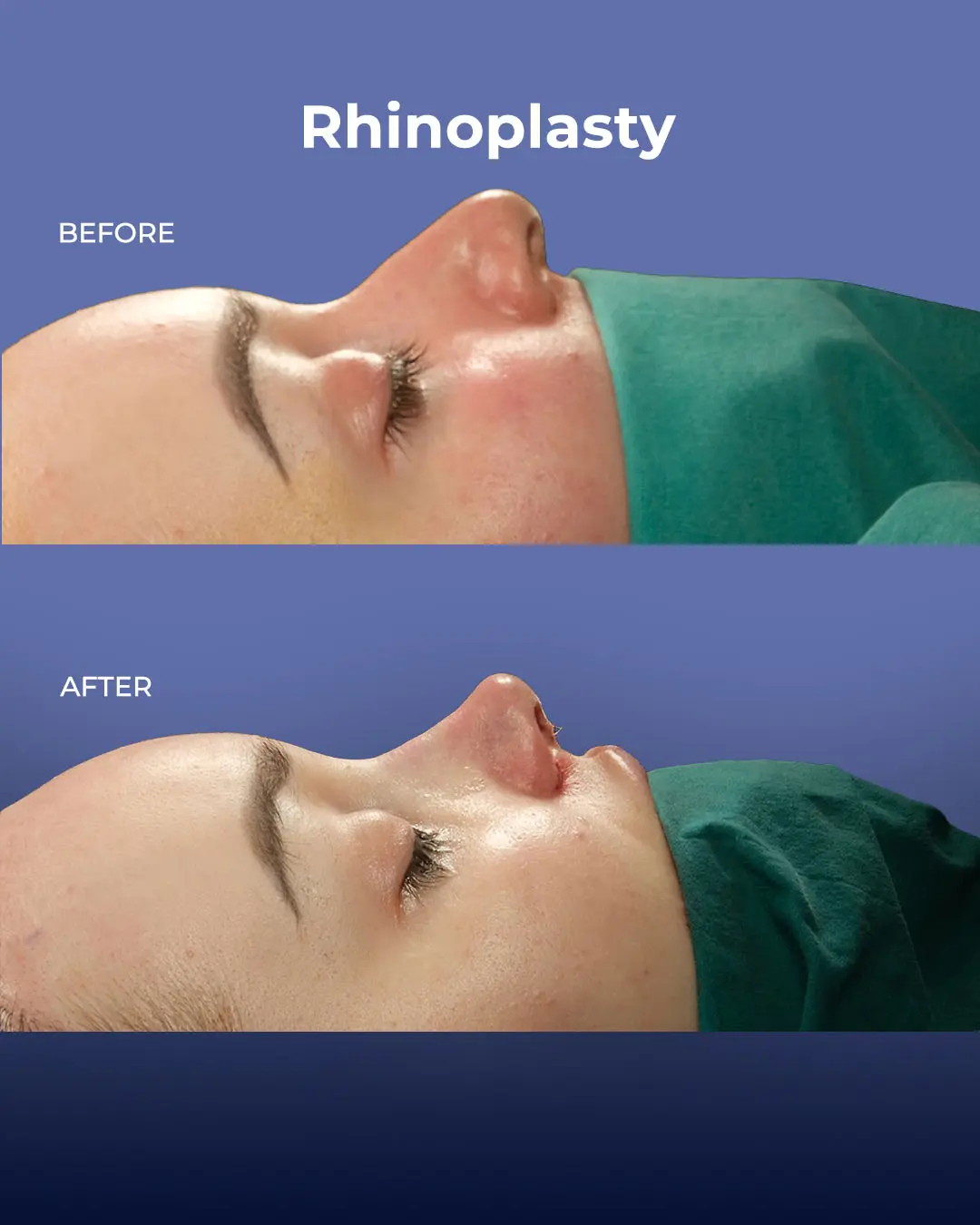 Rhinoplasty Before and After by the Estherian Clinic