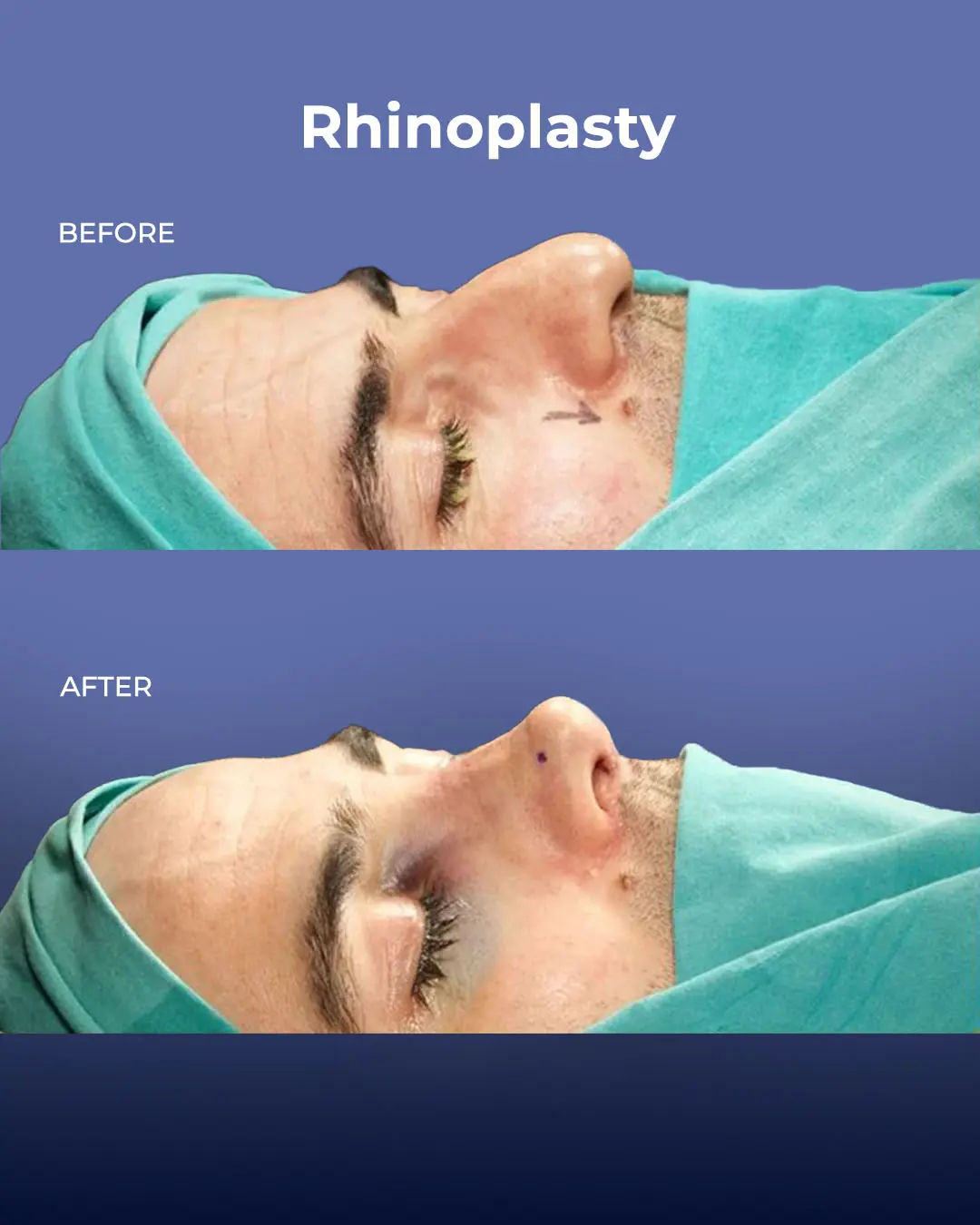 Rhinoplasty Before and After by the Estherian Clinic