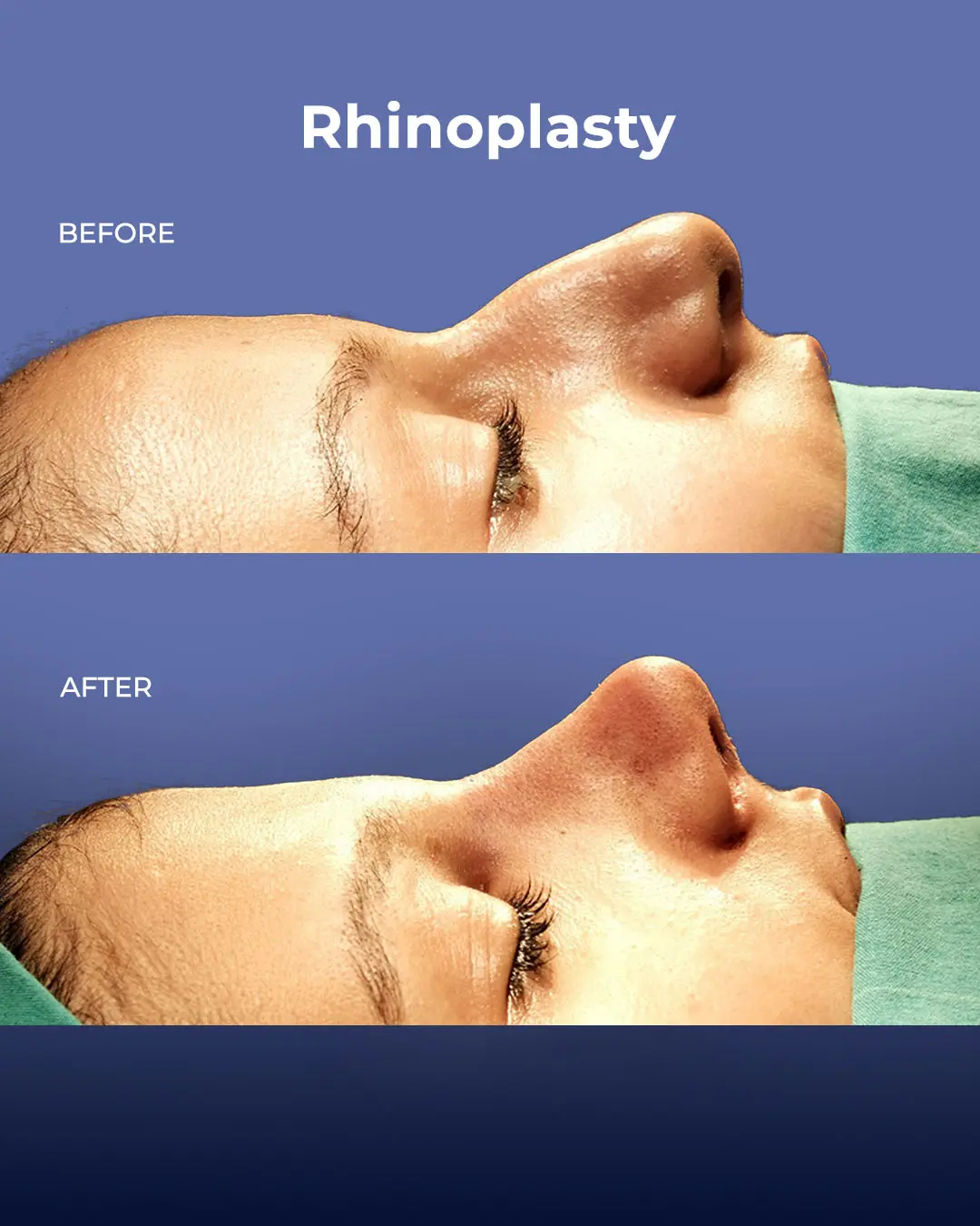 Rhinoplasty Before and After by the Estherian Clinic