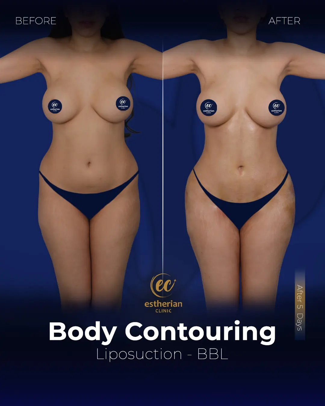 Body Contouring Surgery (before and after) by the Estherian Clinic