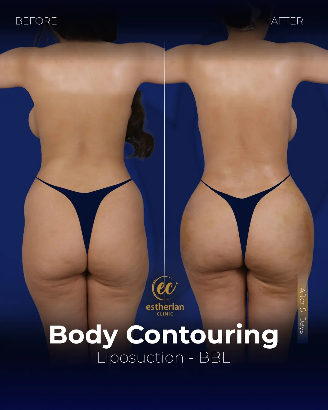 Body Contouring Surgery (before and after) by the Estherian Clinic