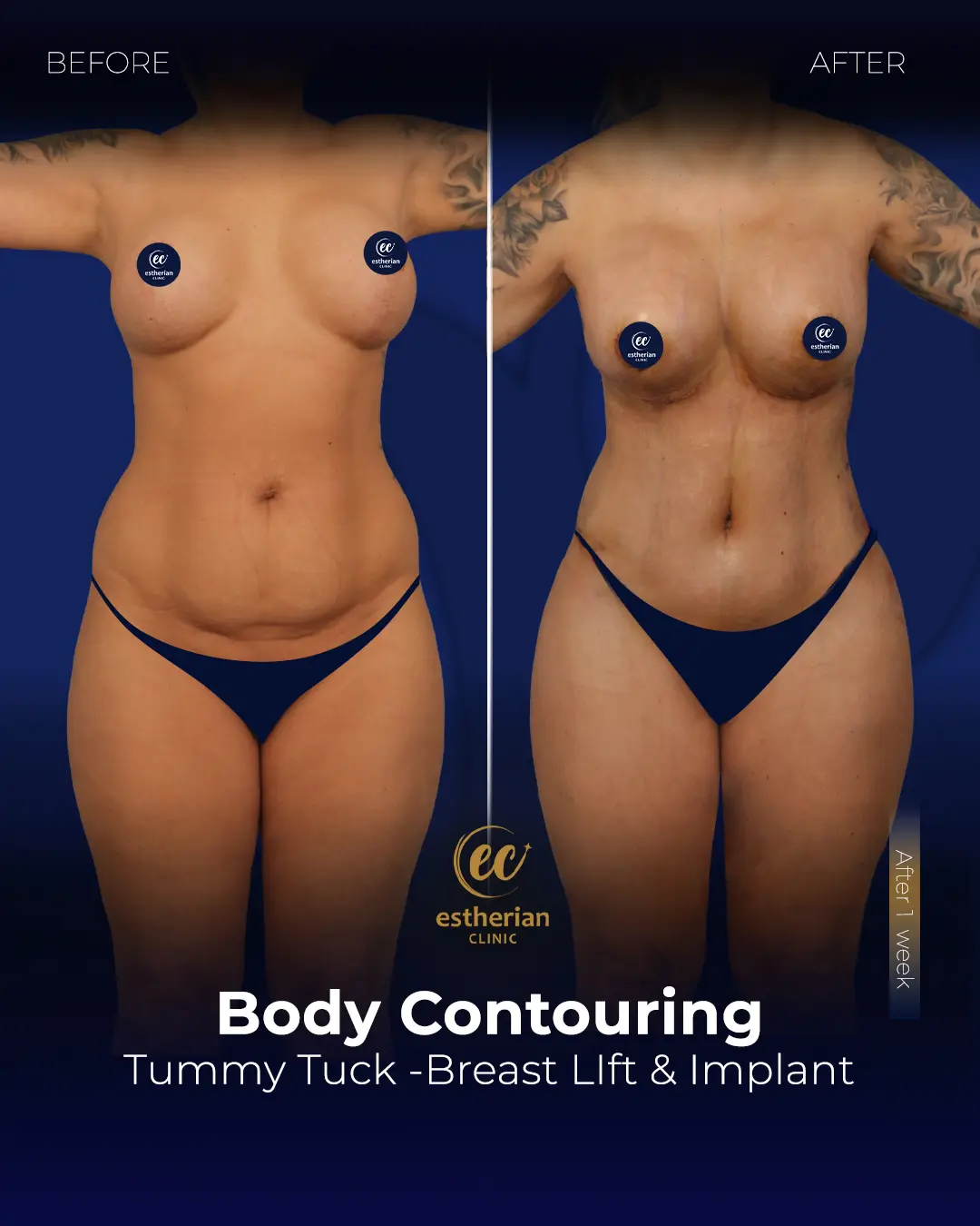 Body Contouring Surgery (before and after) by the Estherian Clinic