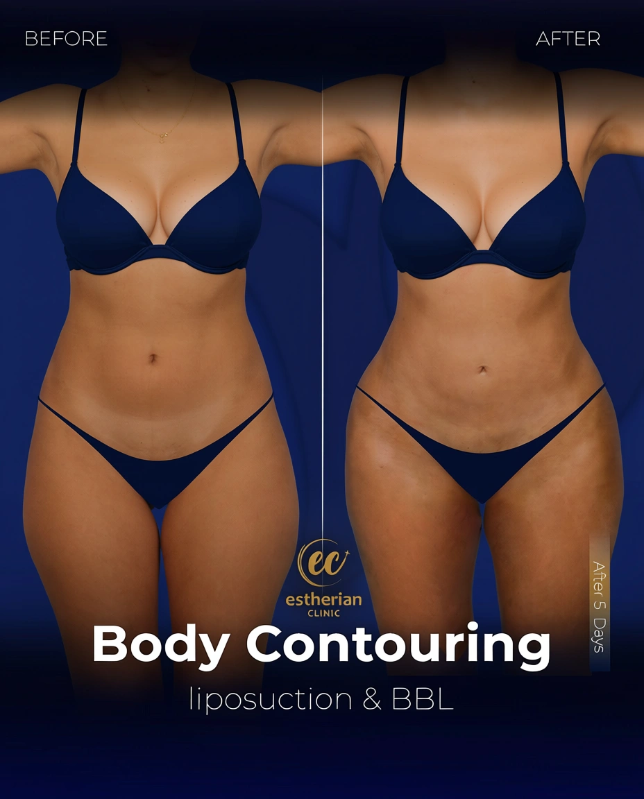 Body Contouring Surgery (before and after) by the Estherian Clinic