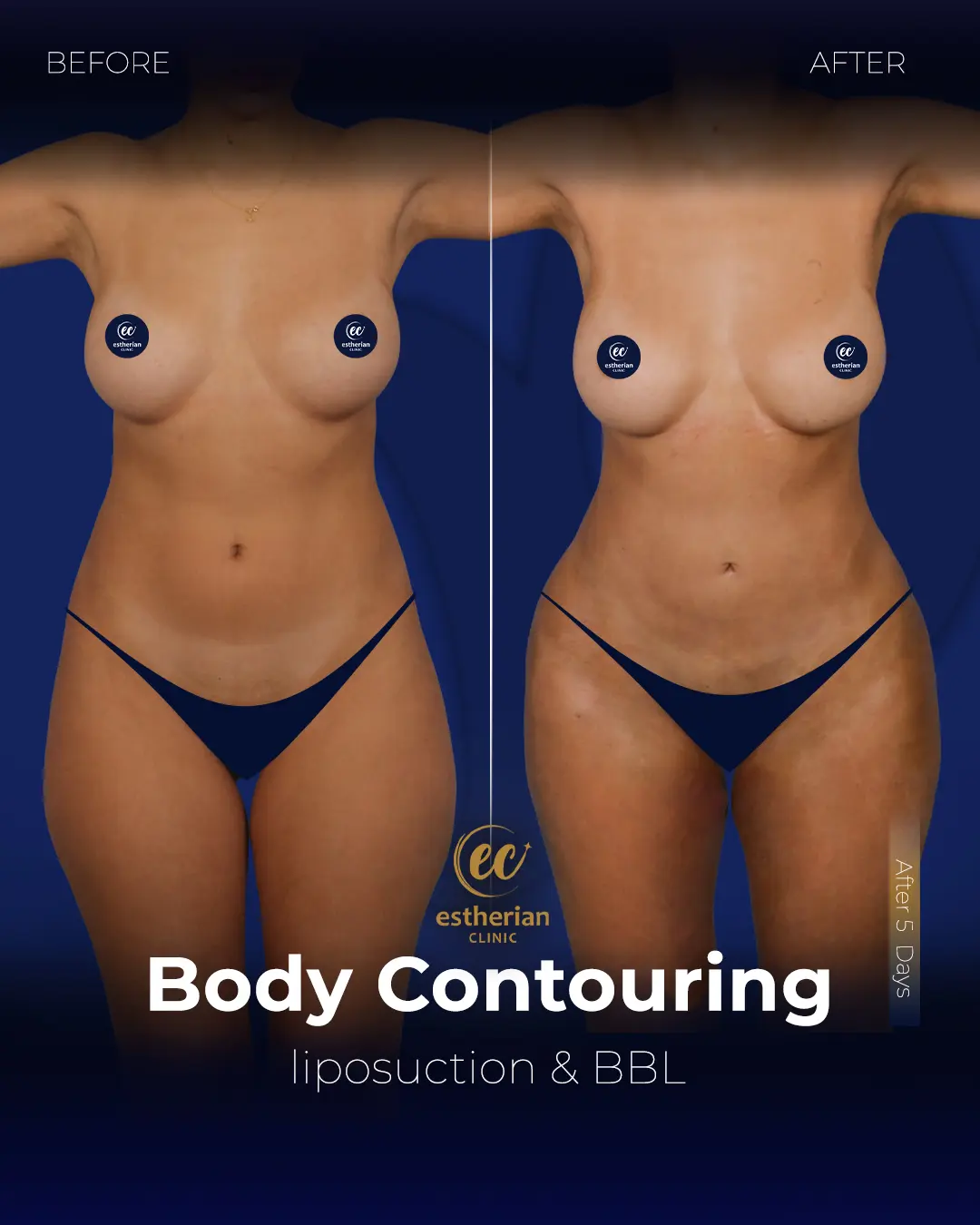 Body Contouring Surgery (before and after) by the Estherian Clinic