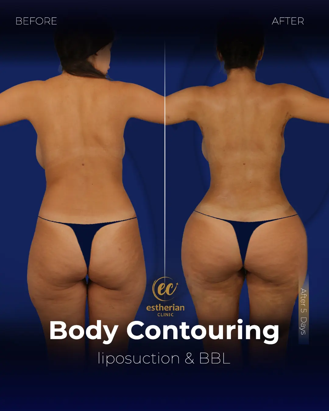 Body Contouring Surgery (before and after) by the Estherian Clinic