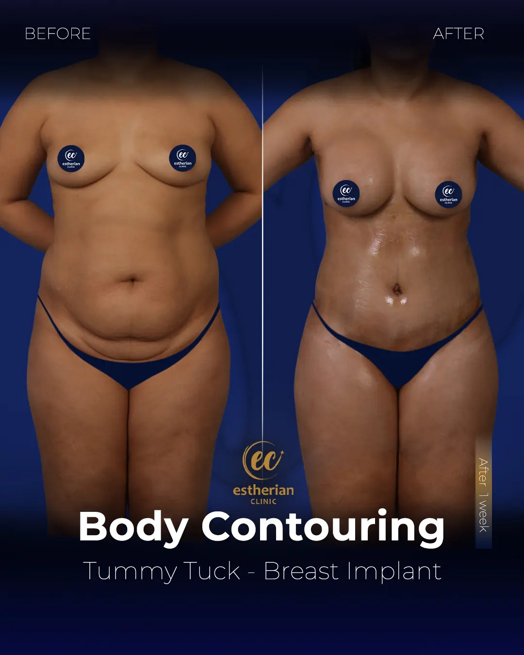 Body Contouring Surgery (before and after) by the Estherian Clinic