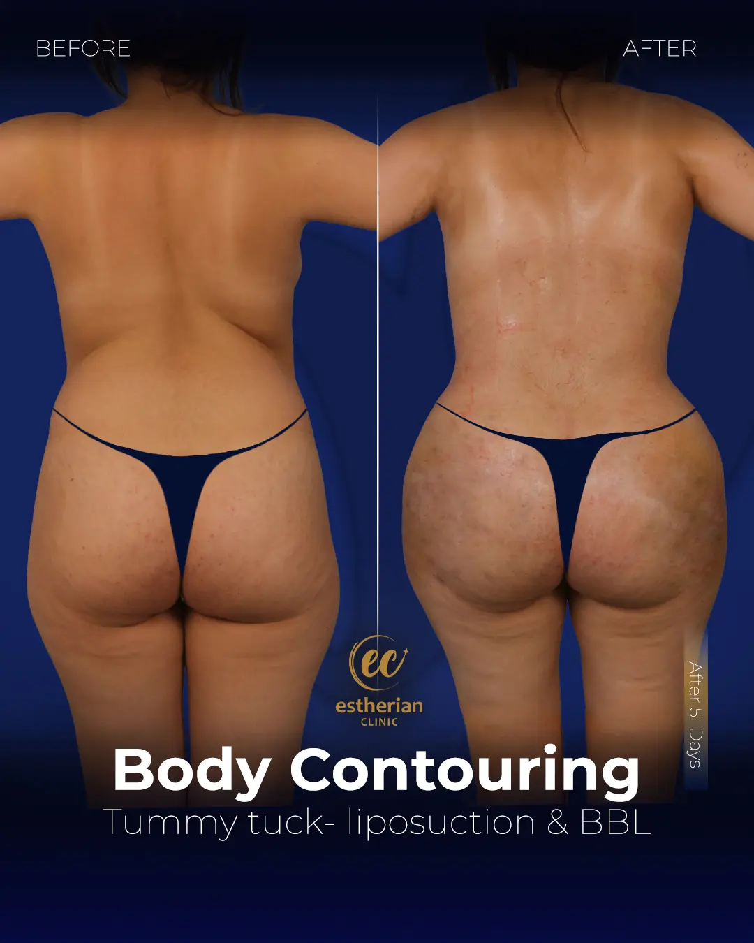 Body Contouring Surgery (before and after) by the Estherian Clinic