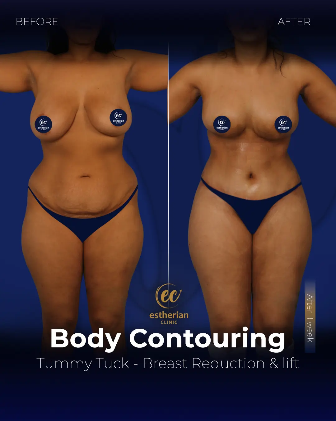 Body Contouring Surgery (before and after) by the Estherian Clinic