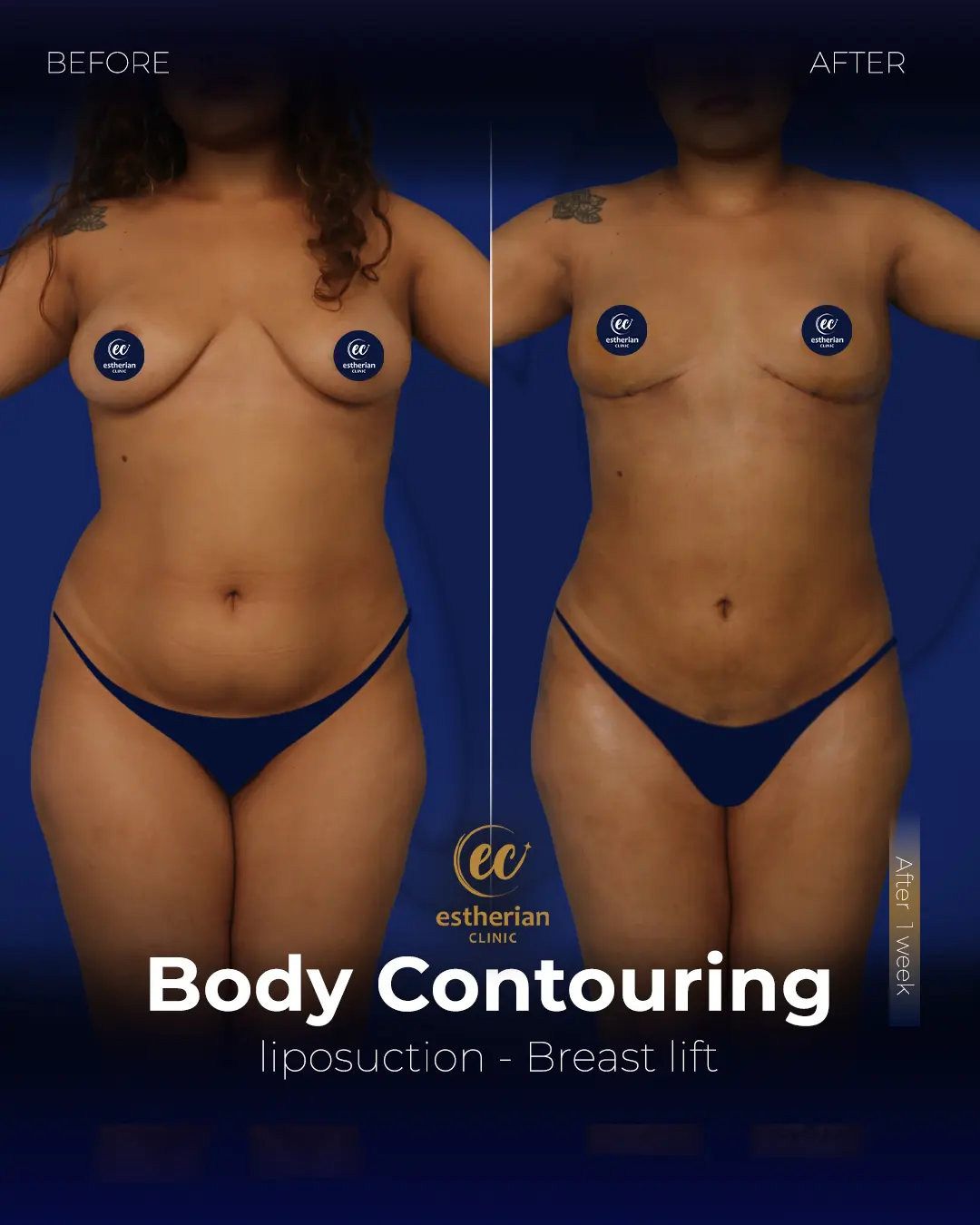 Body Contouring Surgery (before and after) by the Estherian Clinic