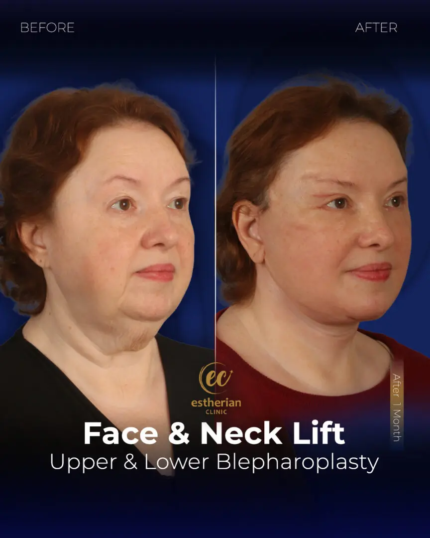 Face and Neck Lift Before and After Gallery by the Estherian Clinic