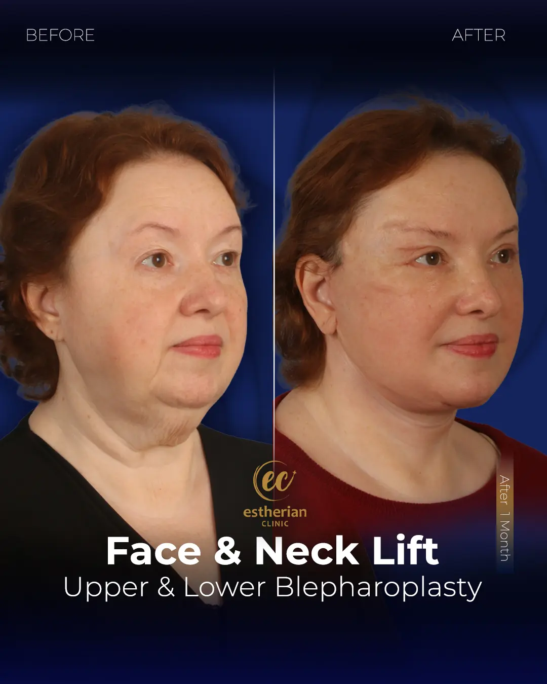 Face and Neck Lift Before and After Gallery by the Estherian Clinic