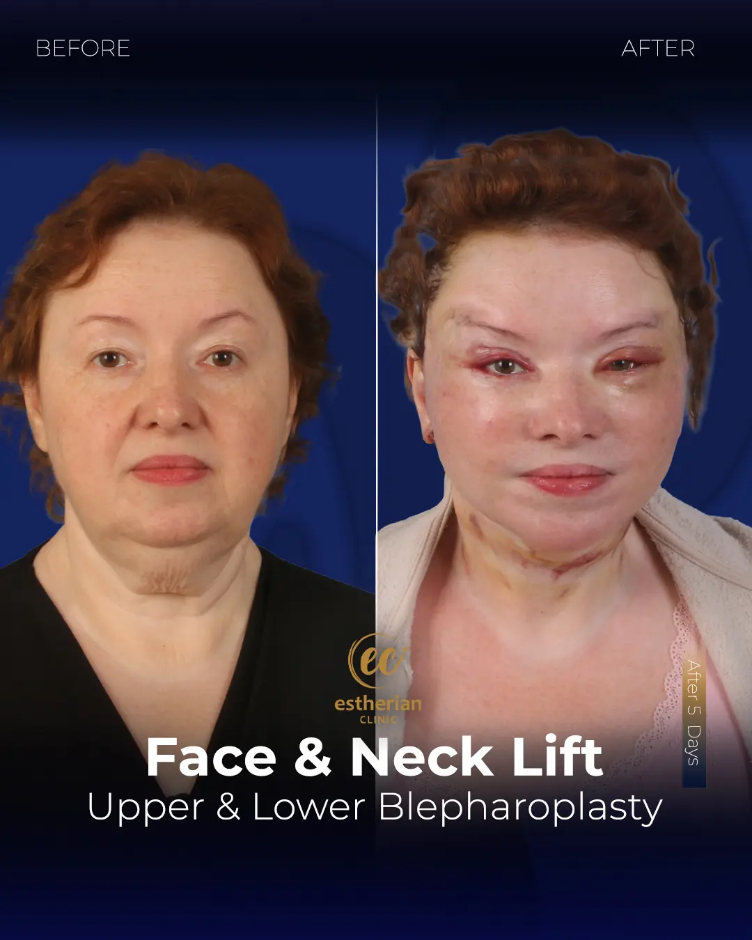 Face and Neck Lift Before and After Gallery by the Estherian Clinic