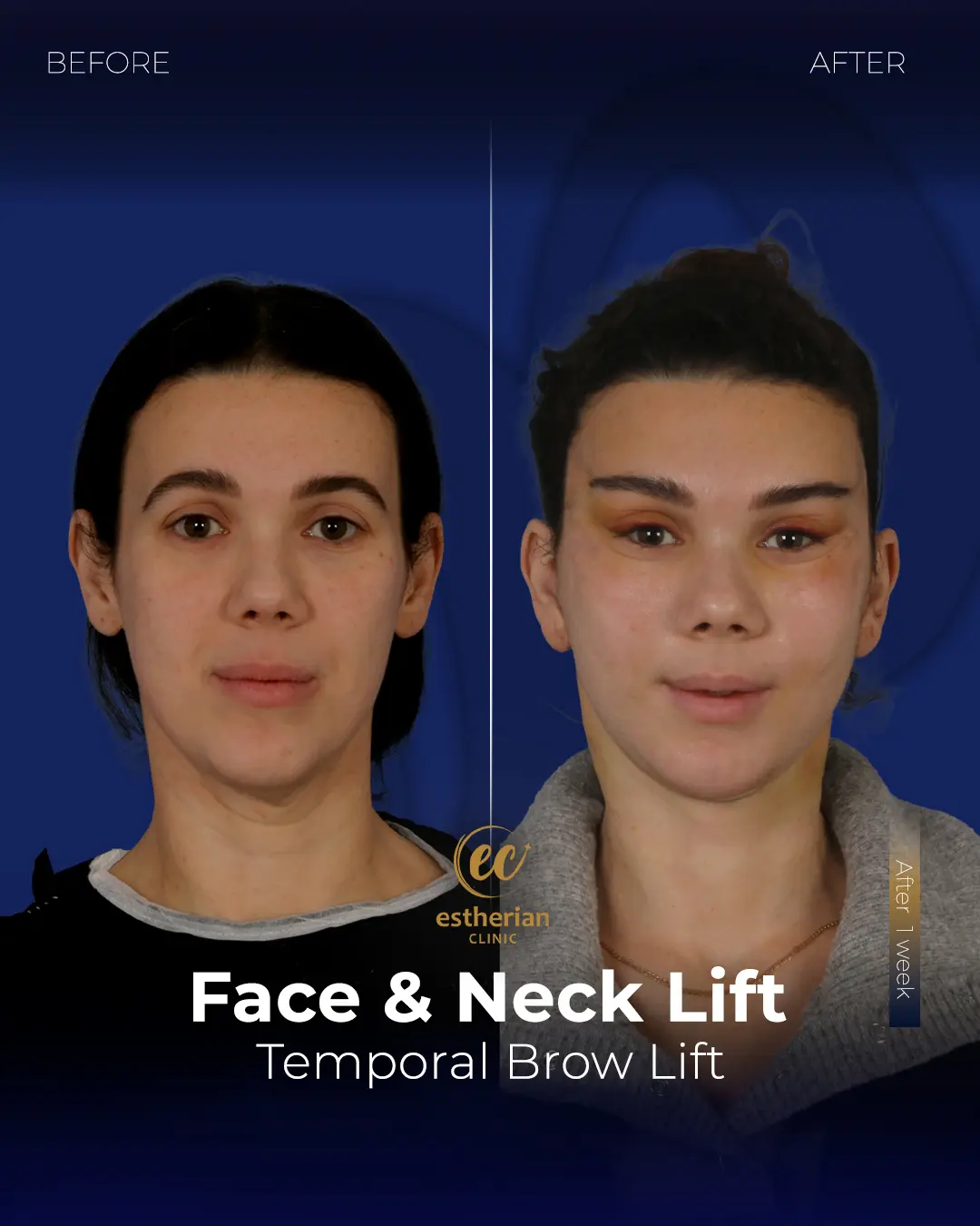 Face and Neck Lift Before and After Gallery by the Estherian Clinic