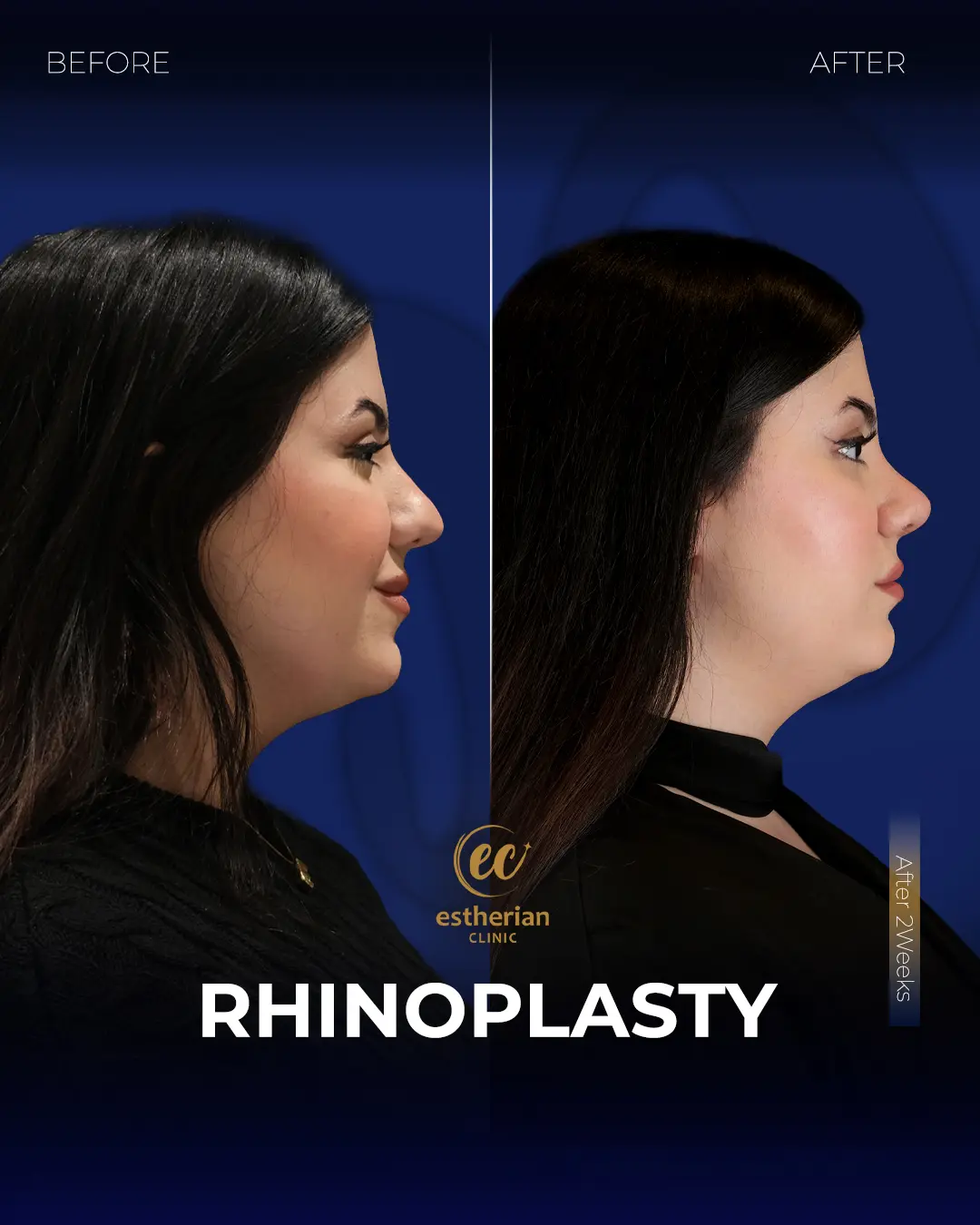 Rhinoplasty Before and After by the Estherian Clinic