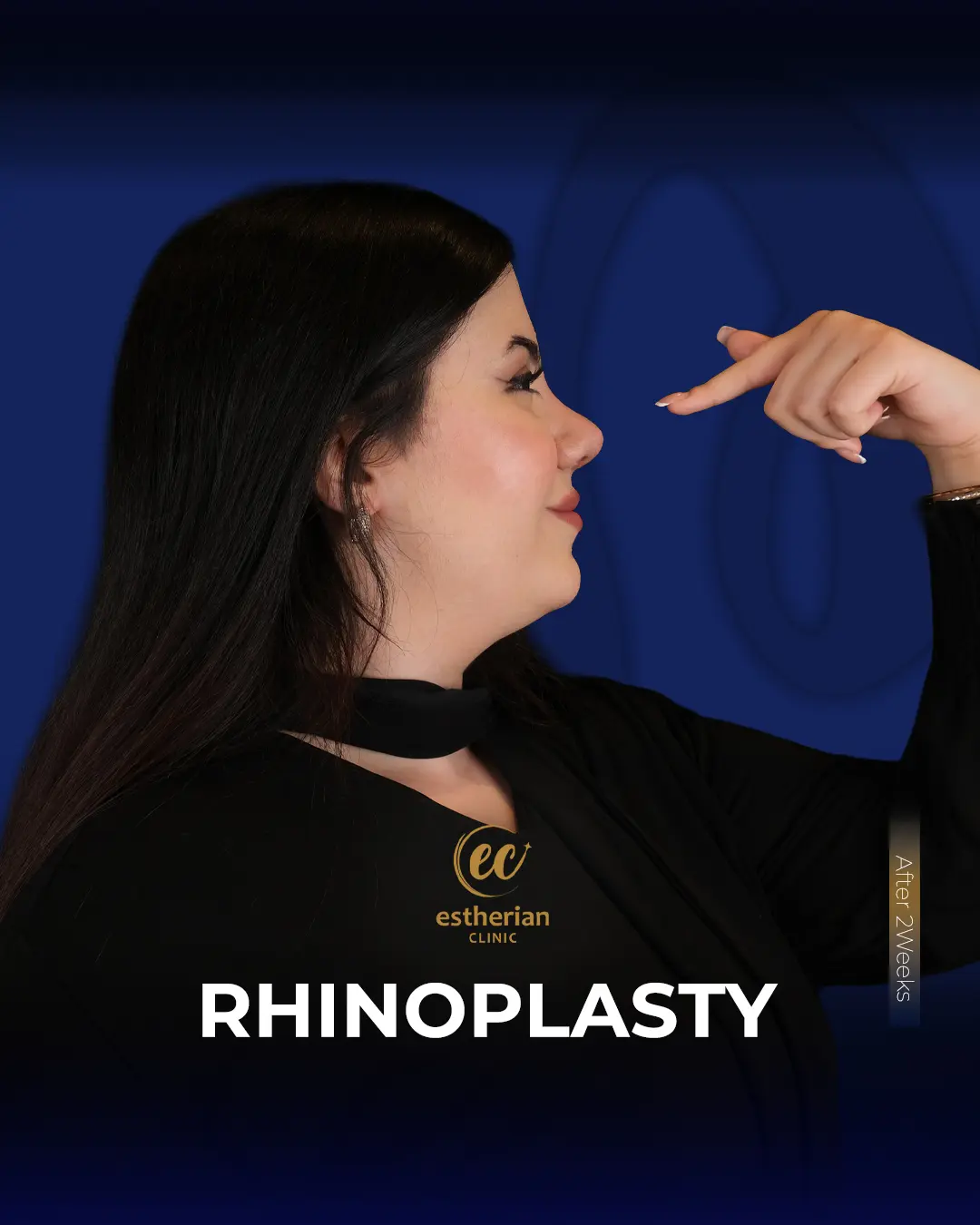 Rhinoplasty Before and After by the Estherian Clinic