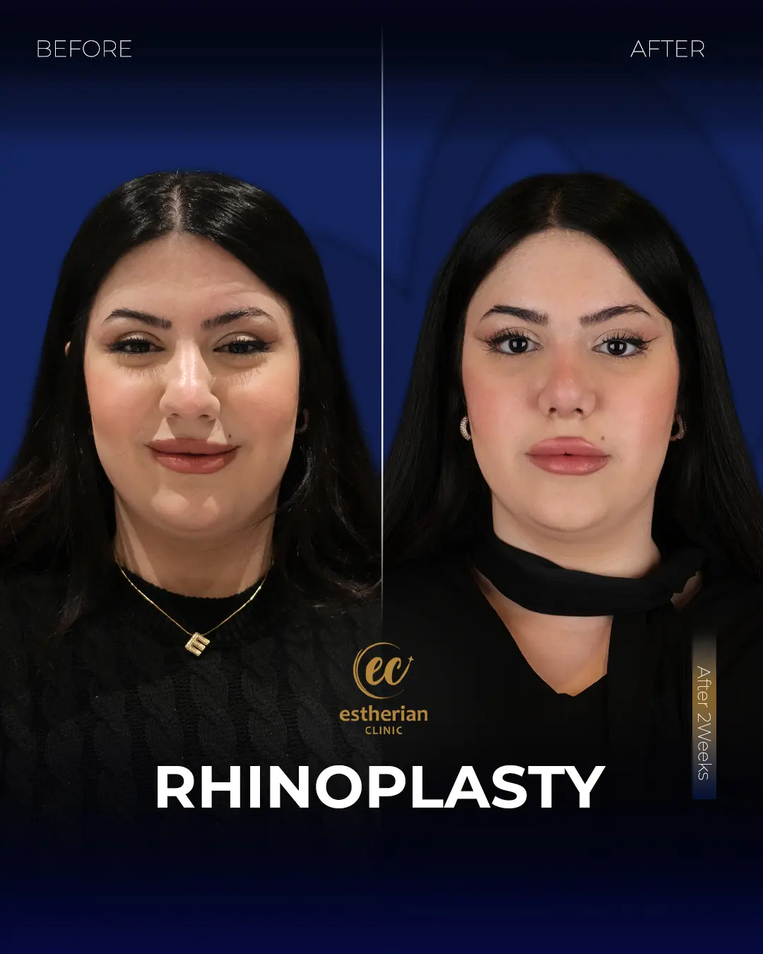 Rhinoplasty Before and After by the Estherian Clinic