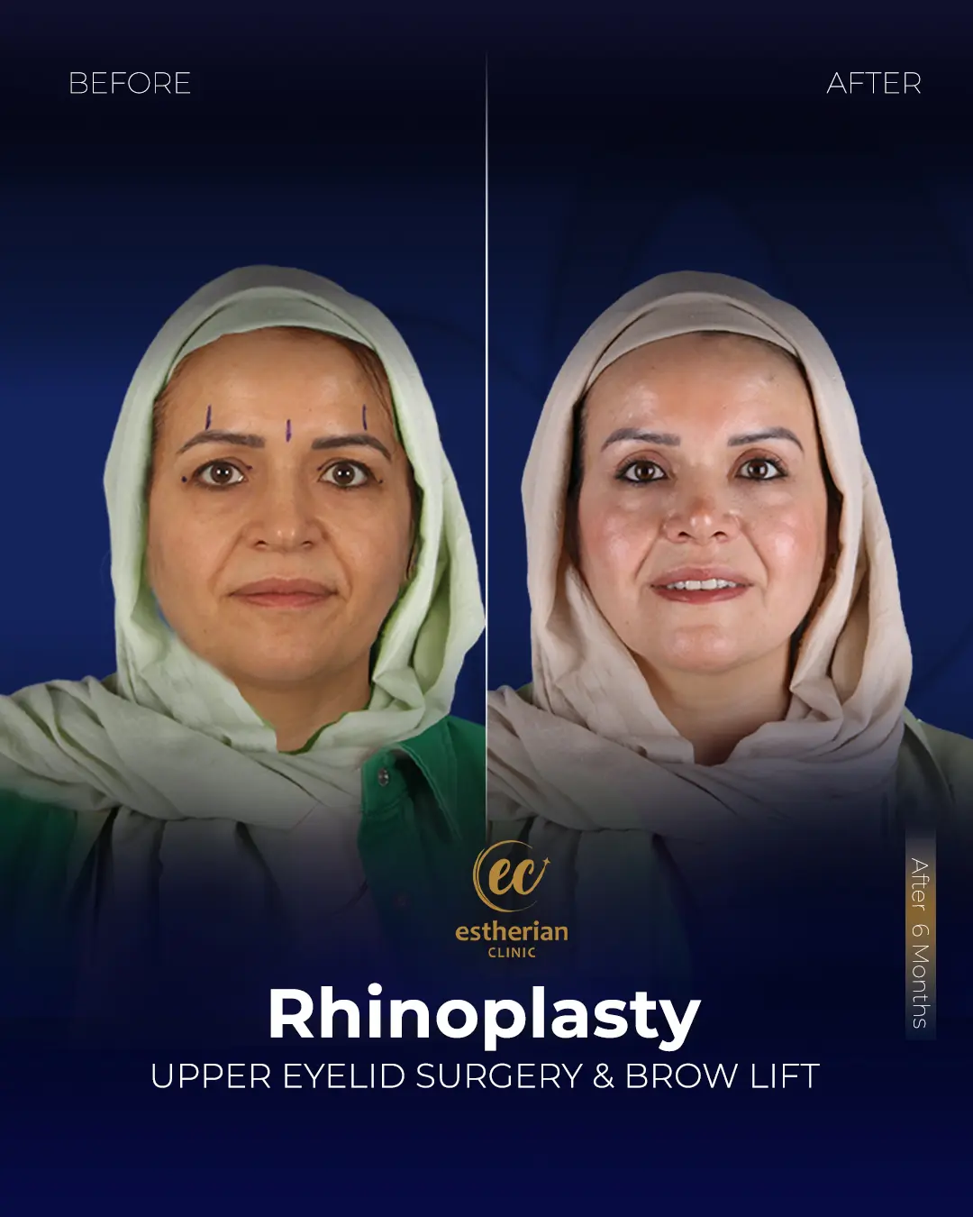Rhinoplasty Before and After by the Estherian Clinic