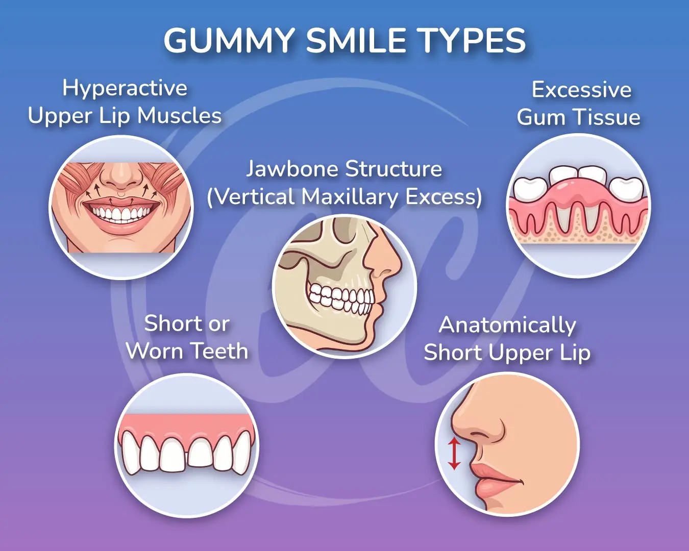 3-D Infographic Showing the Types of Gummy Smiles by the Estherian Clinic