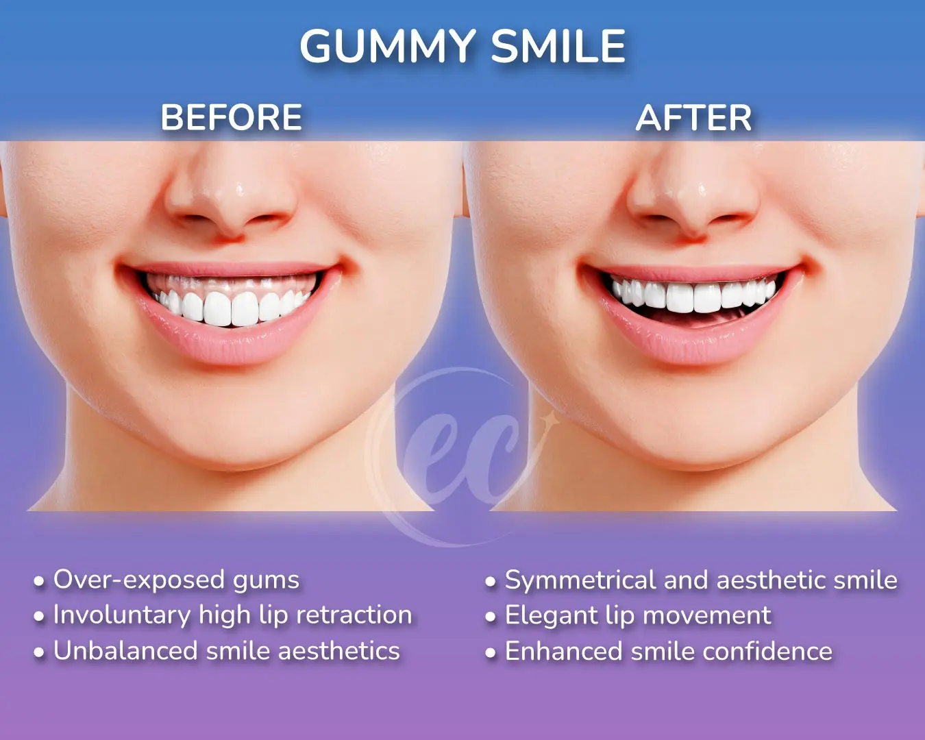 3-D Infographic of a Gummy Smile by the Estherian Clinic