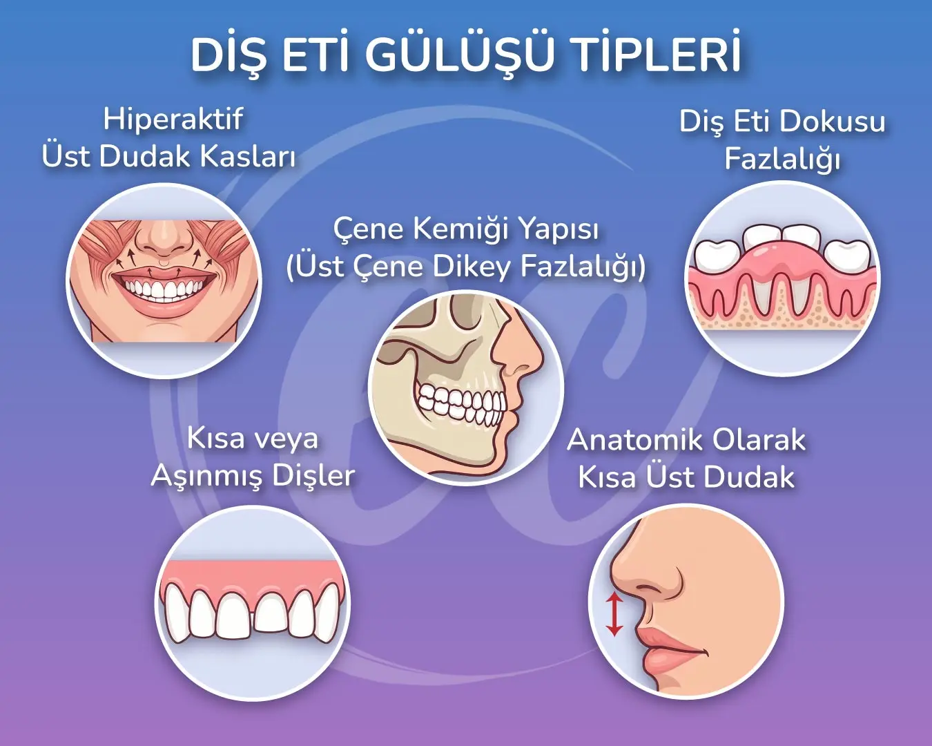 Estherian Clinic Tarafından Hazırlanan, Gummy Smile (Diş Eti Gülüşü) Türlerini Gösteren 3 Boyutlu İnfografik
