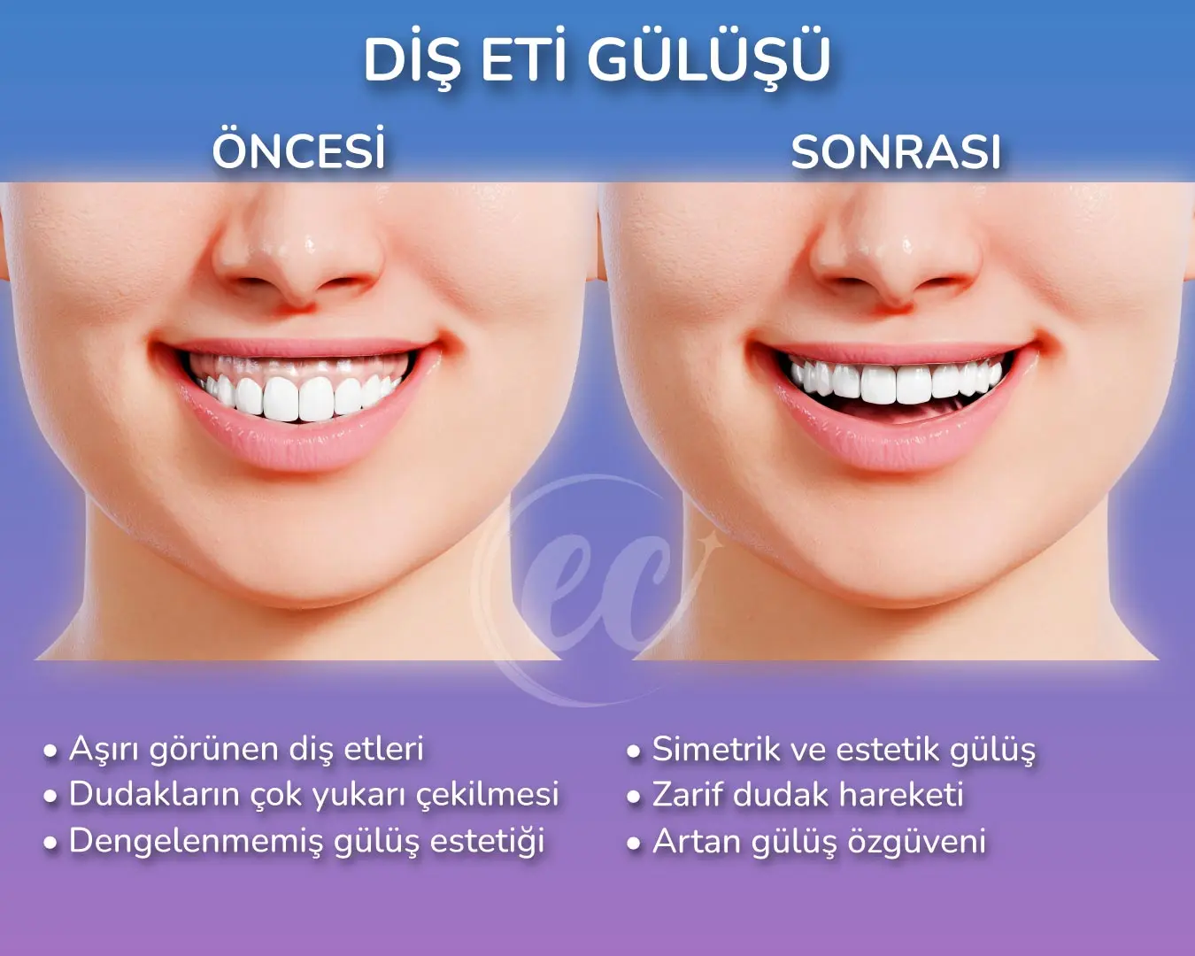 Estherian Clinic'ten Gummy Smile (Diş Eti Gülüşü) için 3 Boyutlu İnfografik