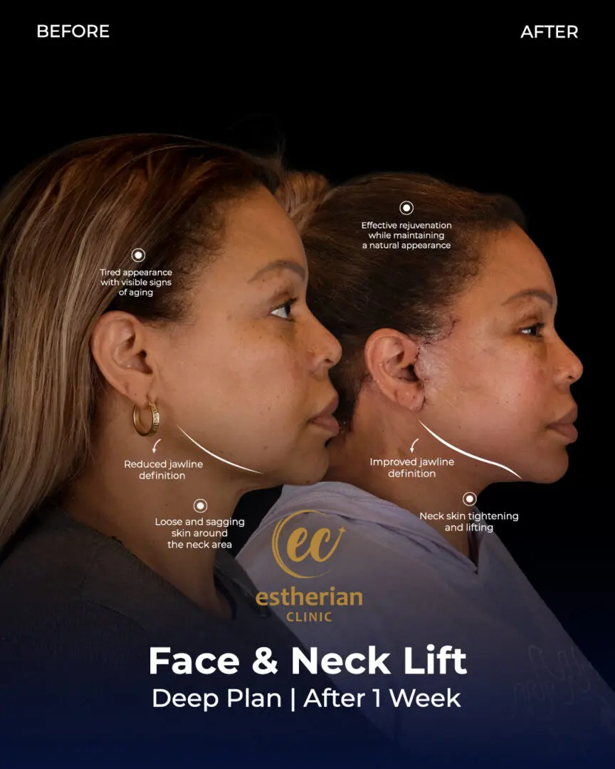 Facelift Before and After by the Estherian Clinic