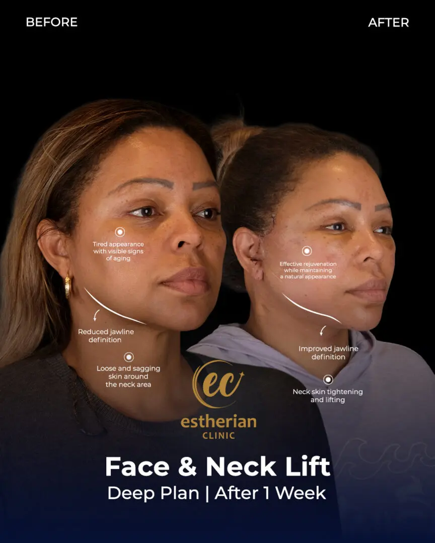 Facelift Before and After by the Estherian Clinic