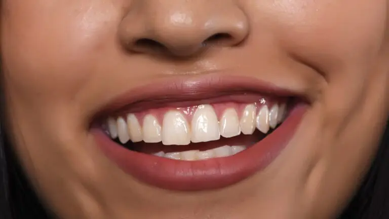 Gummy Smile, Causes, Treatment, and How to Fix it.